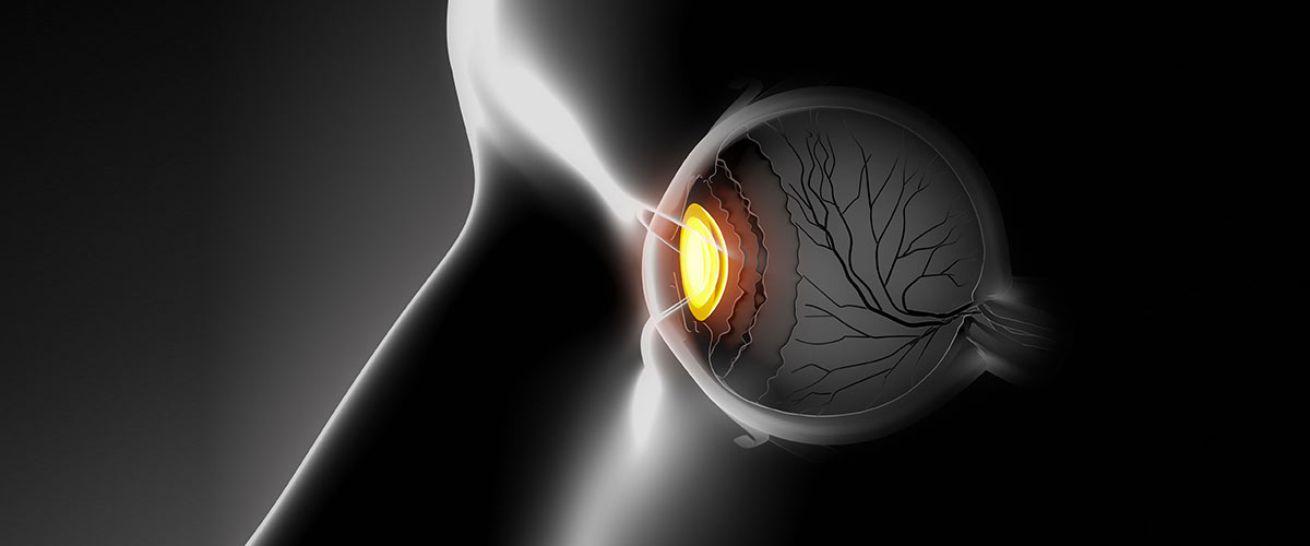 Laser per glaucoma